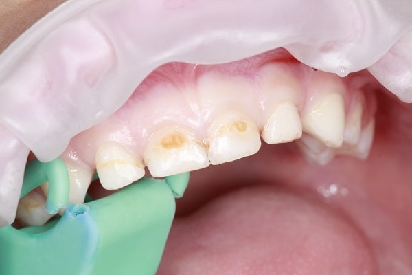 Лечение кариеса детских (молочных) зубов в Омске